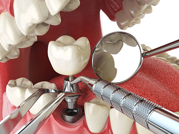 Best Emergency Tooth Extraction in Versailles, MO